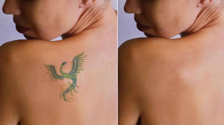 Get The Best Tattoo Removal Treatment At Affordable Prices