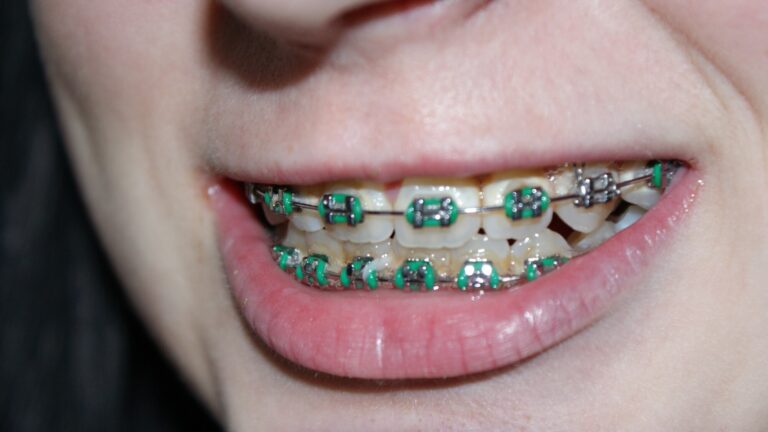 Want to Wear Braces? Know the Benefits of It